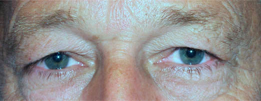 Before treatment — Age 50