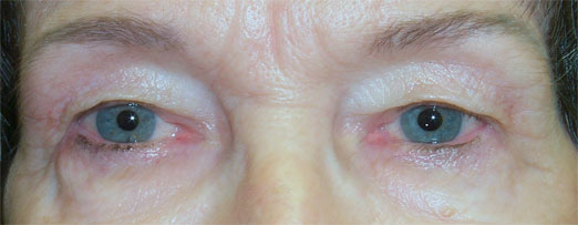 Before treatment — Age 73