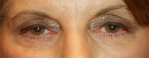 Before treatment — Age 53