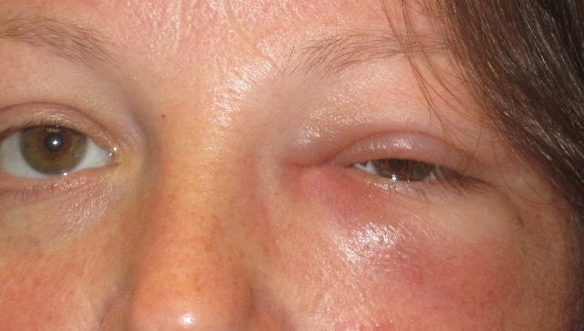 Acute Dacryocystitis - Lacrimal duct infection