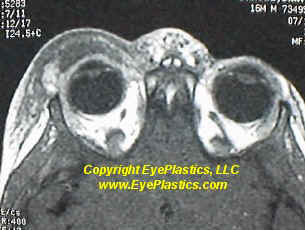 Preseptal cellulitis (periorbital cellulitis)